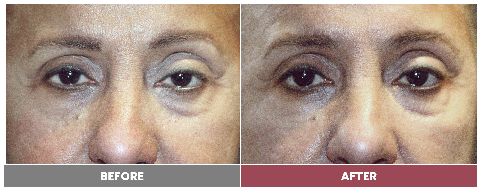 PTOSIS REPAIR - Case 61